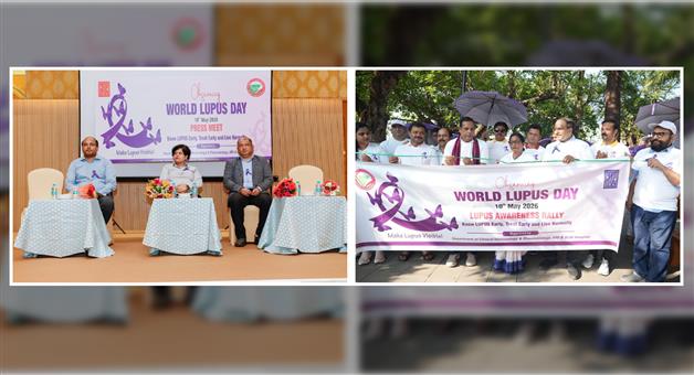 Khabar Odisha:EARLY-DIAGNOSIS-CAN-HELP-BATTLE-LUPUS-EXPERT