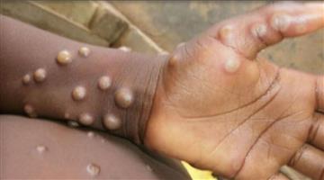 Khabar Odisha:International-Monkeypox-sevior-situation-in-Europe-case-symptom-vaccine-WHO