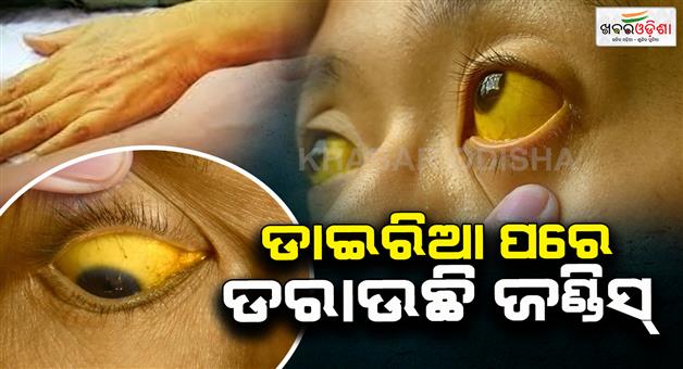 Khabar Odisha:Jaundice-raises-concern-in-Mayurbhanj-40-cases-detected-from-2-villages