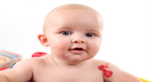 Khabar Odisha:Why-do-babies-have-birthmarks-at-birth-What-experts-say