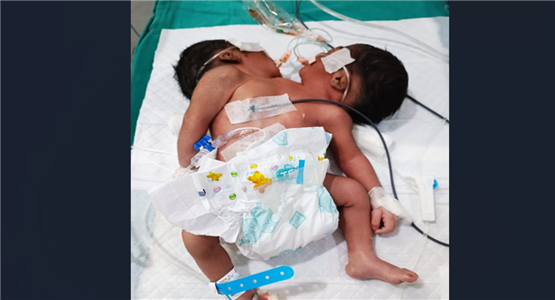 Khabar Odisha:cojoined-twins-died-at-mkcg