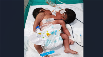 Khabar Odisha:cojoined-twins-died-at-mkcg