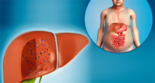 Khabar Odisha:diabetes-patients-liver-fibrosis-risk-india-study-revelation