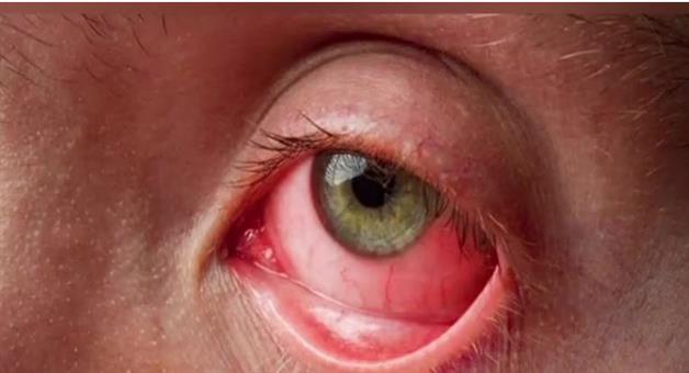 Khabar Odisha:eye-disease-is-striking-this-month-warning--issued-health-department